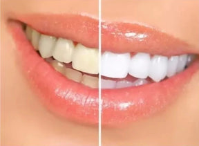 Clareador Dental Whiteness Perfect 16% - 2 Un + 1 Par de Moldeiras