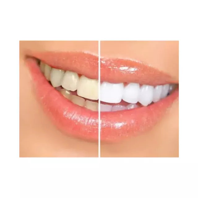 Clareador Dental Whiteness Simple 22% - 3 Un + 1 Par de Moldeiras